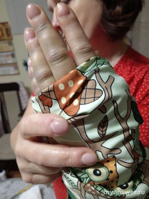 Перелом запястья руки, почему у меня меня синие пальцы?