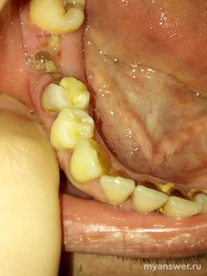 Сможете определить по фото удалил ли стоматолог корни зуба?