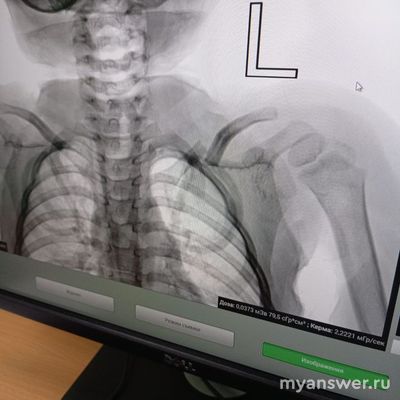 Насколько опасен невправленный перелом ключицы со смещением?