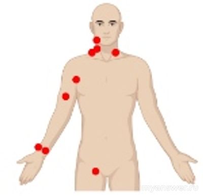 Каким областям соответствуют места пережатия сосудов при кровотечениях?