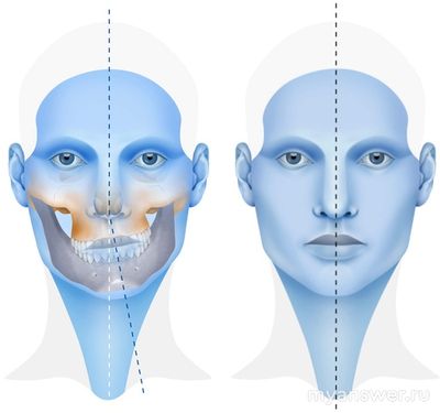 Можете мне объяснить, чем мне помогут брекеты для лечения ВНЧС?