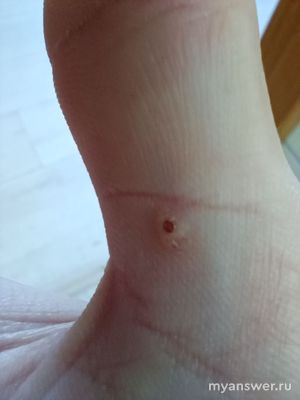 Какая-то шишечка на коже большого пальца руки, что это, что делать!?