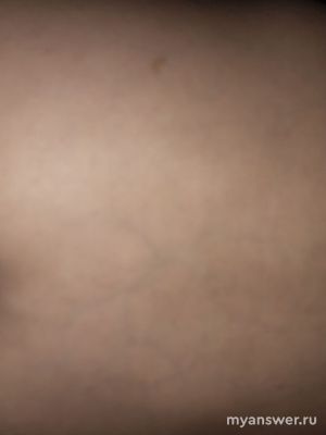 У ребёнка болит копчик и на пояснице видны сосуды, что делать?