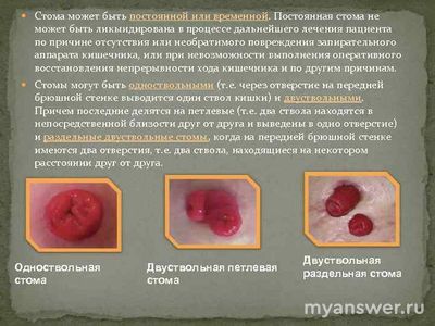 Жизнь со стомой это, разве, приговор?