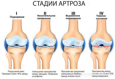 Что вам эффективно помогает поддерживать здоровье и крепость суставов?